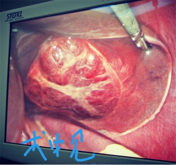 3.26腹腔鏡左肝外側(cè)葉切除微創(chuàng)手術(shù) 在新余第四醫(yī)院獲得成功192.jpg